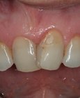 Výchozí stav – nevyhovující tvar, sklon a barva zubů (vlevo) a zuby po úpravě pomocív estetických faset (vpravo)