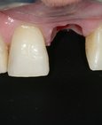 Stav před implantací (vlevo) a po implantaci (vpravo) 