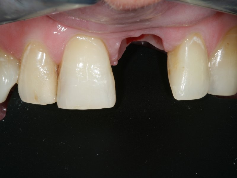 Stav před implantací (vlevo) a po implantaci (vpravo) 