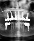 Brannemarkův můstek na šesti implantátech v horní čelisti a dva implantáty v dolní čelisti s volným členem navíc