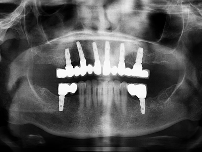 Brannemarkův můstek na šesti implantátech v horní čelisti a dva implantáty v dolní čelisti s volným členem navíc