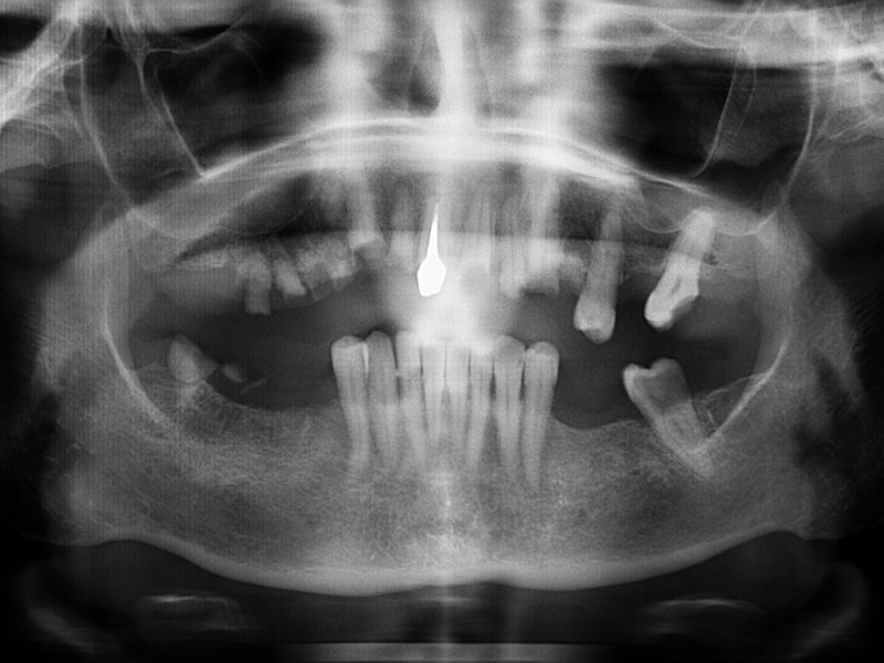 Stav před implantací (vlevo) a po implantaci (vpravo)