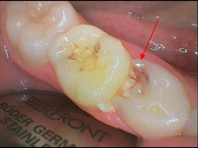 Extrakcia zuba u deti