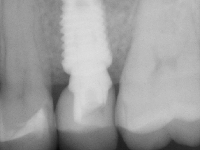 Rentgen implantátu s korunkou