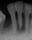 Úbytek kosti v oblasti dolního řezáku, vpravo kostní regenerace po pečlivé dentální hygieně