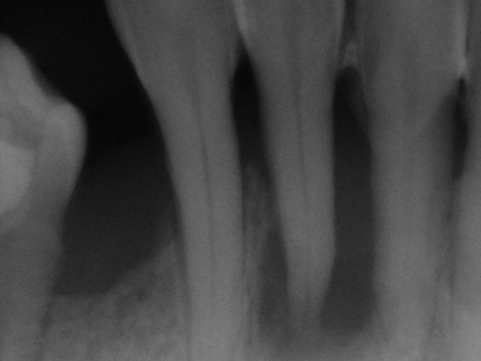 Úbytek kosti v oblasti dolního řezáku, vpravo kostní regenerace po pečlivé dentální hygieně