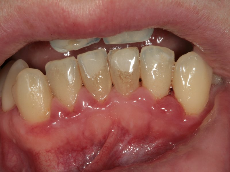 Zubní kámen na dolních řezácích a zanícené oteklé dásně, vpravo stav po dentální hygieně