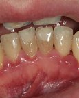 Zubní kámen na dolních řezácích a zanícené oteklé dásně, vpravo stav po odstranění zubního kamene a zhojení zanětu