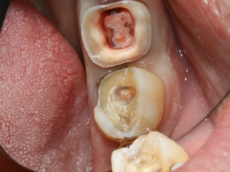Rozsah destrukce zubu, zuby již napreparované pro keramické náhrady