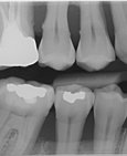 Zubní kámen pod dásní a s tím související horizontální úbytek kosti v obou čelistech – parodontitida