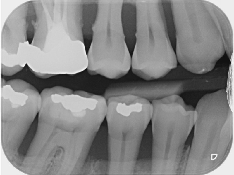Zubní kámen pod dásní a s tím související horizontální úbytek kosti v obou čelistech – parodontitida