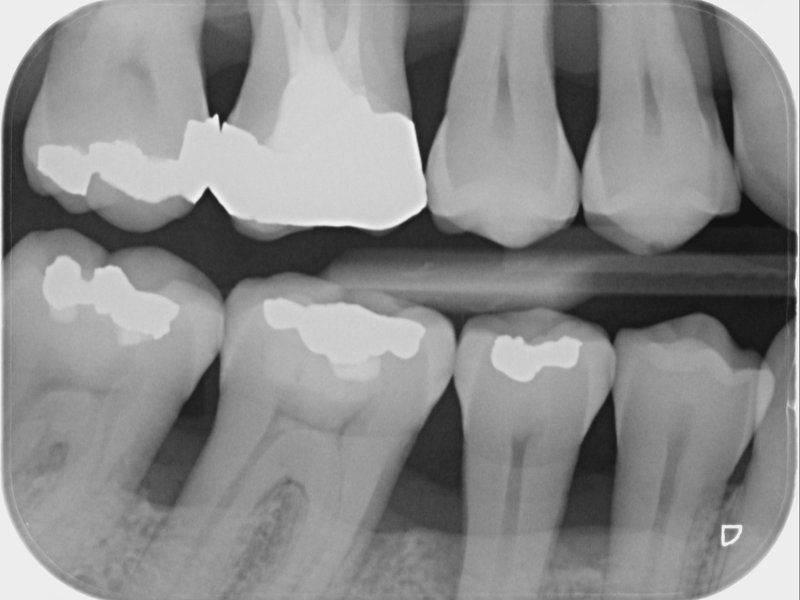 Hladký povrch zubů po profesionálním odstranění zubního kamene