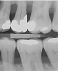 Hladký povrch zubů po profesionálním odstranění zubního kamene