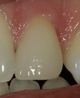 Výsledný estetický efekt – změna tvaru zubu (plus předcházející bělení všech zubů)