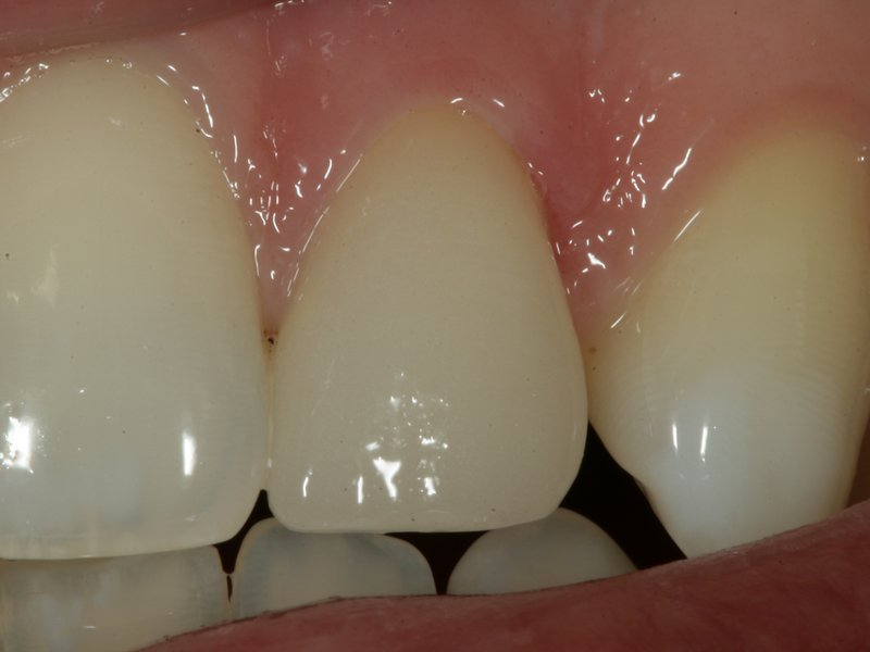 Výsledný estetický efekt – změna tvaru zubu (plus předcházející bělení všech zubů)