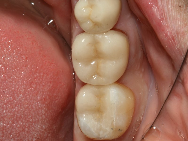 Keramické overlaye (vlevo) na šestce a sedmičce a celokeramická korunka na pětce z důvodu rozsáhlé kazivé destrukce zubů (vpravo)