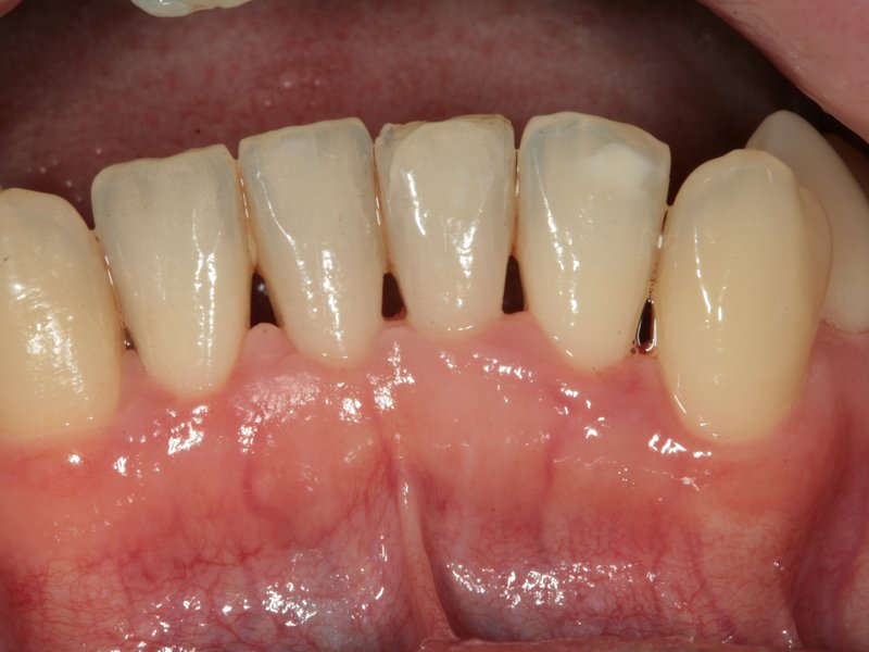 Stav po odstranění zubního kamene a zhojení zánětu dásní