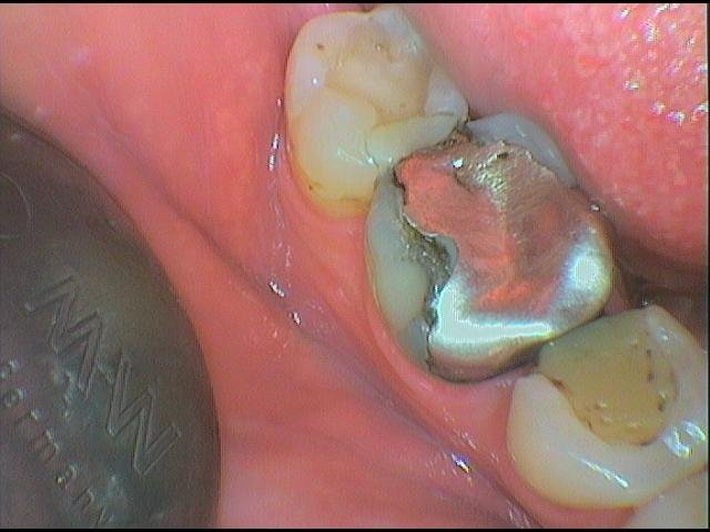 Nevyhovující amalgámová výplň a vpravo výměna za kompozitní výplň