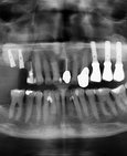 Implantace v horní čelisti v kombinaci se sinus liftem – doplnění umělého kostního materiálu po předchozím nadzvednutí membrány vystýlající čelistní dutinu