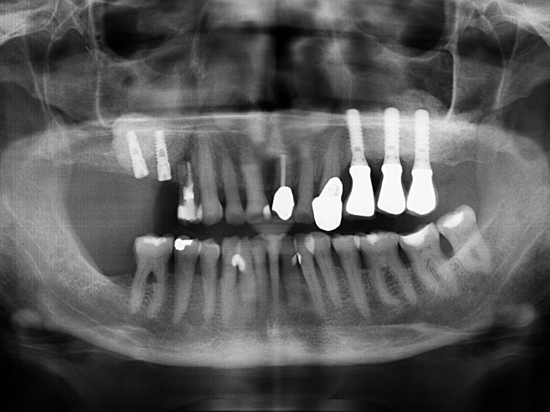 Implantace v horní čelisti v kombinaci se sinus liftem – doplnění umělého kostního materiálu po předchozím nadzvednutí membrány vystýlající čelistní dutinu