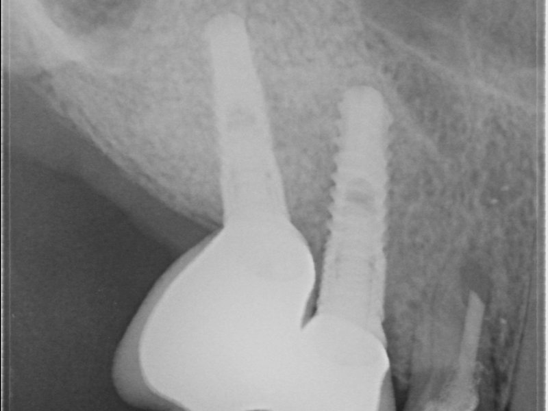 Umělý kostní materiál v okolí implantátu