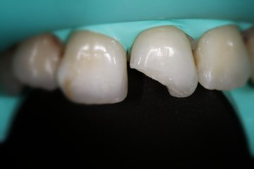 Úrazy zubů