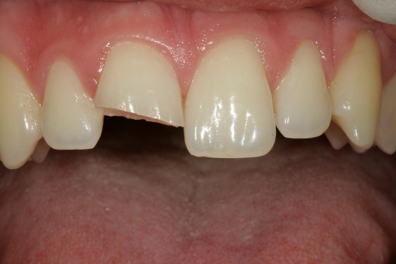 Blog - Jak se zachovat při úrazech zubů?