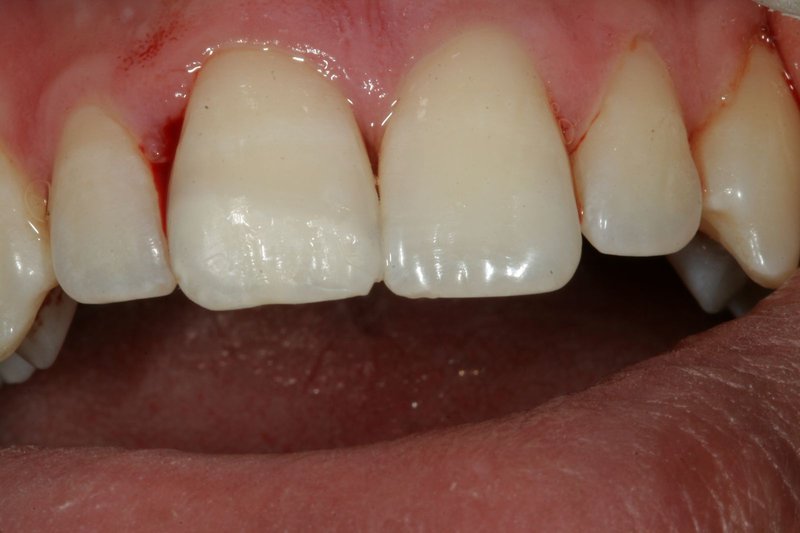 Blog - Jak se zachovat při úrazech zubů?