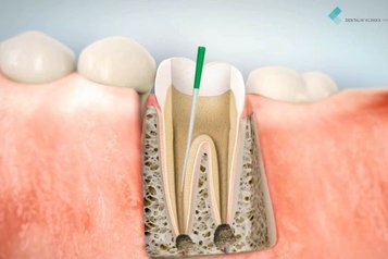 Endodontické ošetření zubu