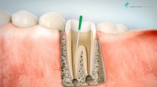 Endodontické ošetření zubu