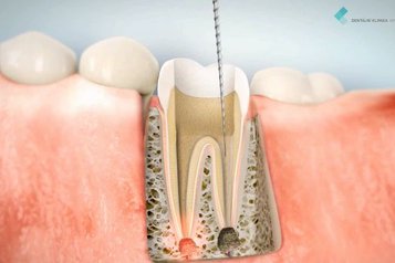 Reendodontické ošetření zubu