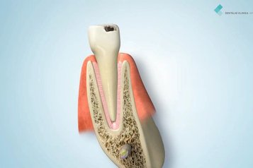 Jednoduchá extrakce zubu a následné zhojení rány