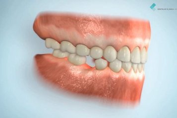 Následky odkládání řešení chybějícího zubu