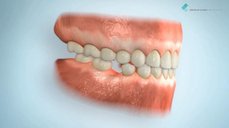 Následky odkládání řešení chybějícího zubu