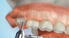 Chirurgická extrakce neprořezaného zubu