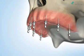 Implantologické fixní řešení bezzubé horní čelisti