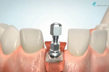Implantologické řešení jednoho chybějícího zubu