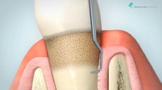 Odstranění subgingiválního zubního kamene