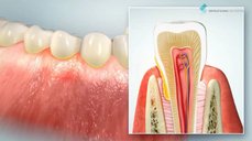 Průběh zánětu parodontálních tkání