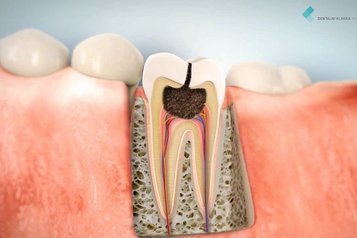 Zubní kaz a jeho komplikace, pokud se včas neodstraní