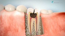 Zubní kaz a jeho komplikace, pokud se včas neodstraní