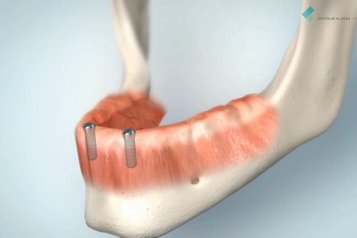Řešení bezzubé dolní čelisti pomocí snímatelné náhrady kotvené na dvou implantátech