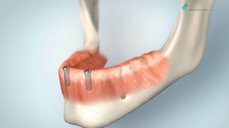 Řešení bezzubé dolní čelisti pomocí snímatelné náhrady kotvené na dvou implantátech