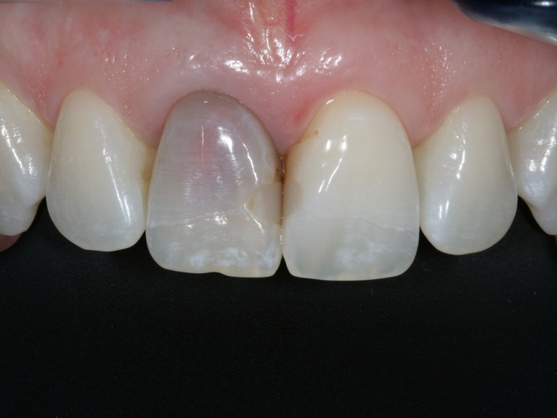 Vnitřní bělení zubu - před a vpravo po vnitřním bělení