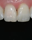 Vnitřní bělení zubu - po