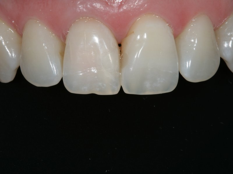 Vnitřní bělení zubu - po